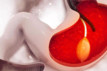 ما هو بالون المعدة؟